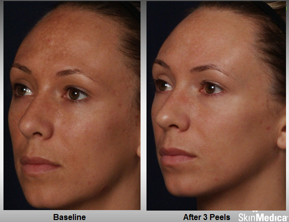 rejuvenize_case_1_after_3_peels