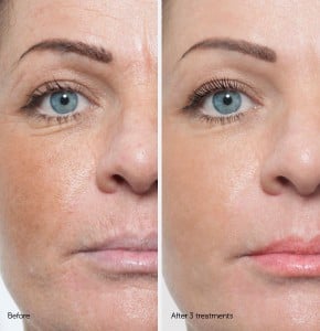before-and-after-microneedling-silktouch-med-spa-290x300